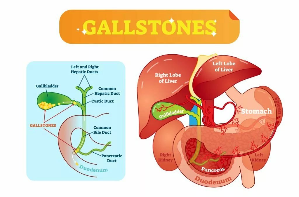 Gallstones anatomical cross-section - vector illustration