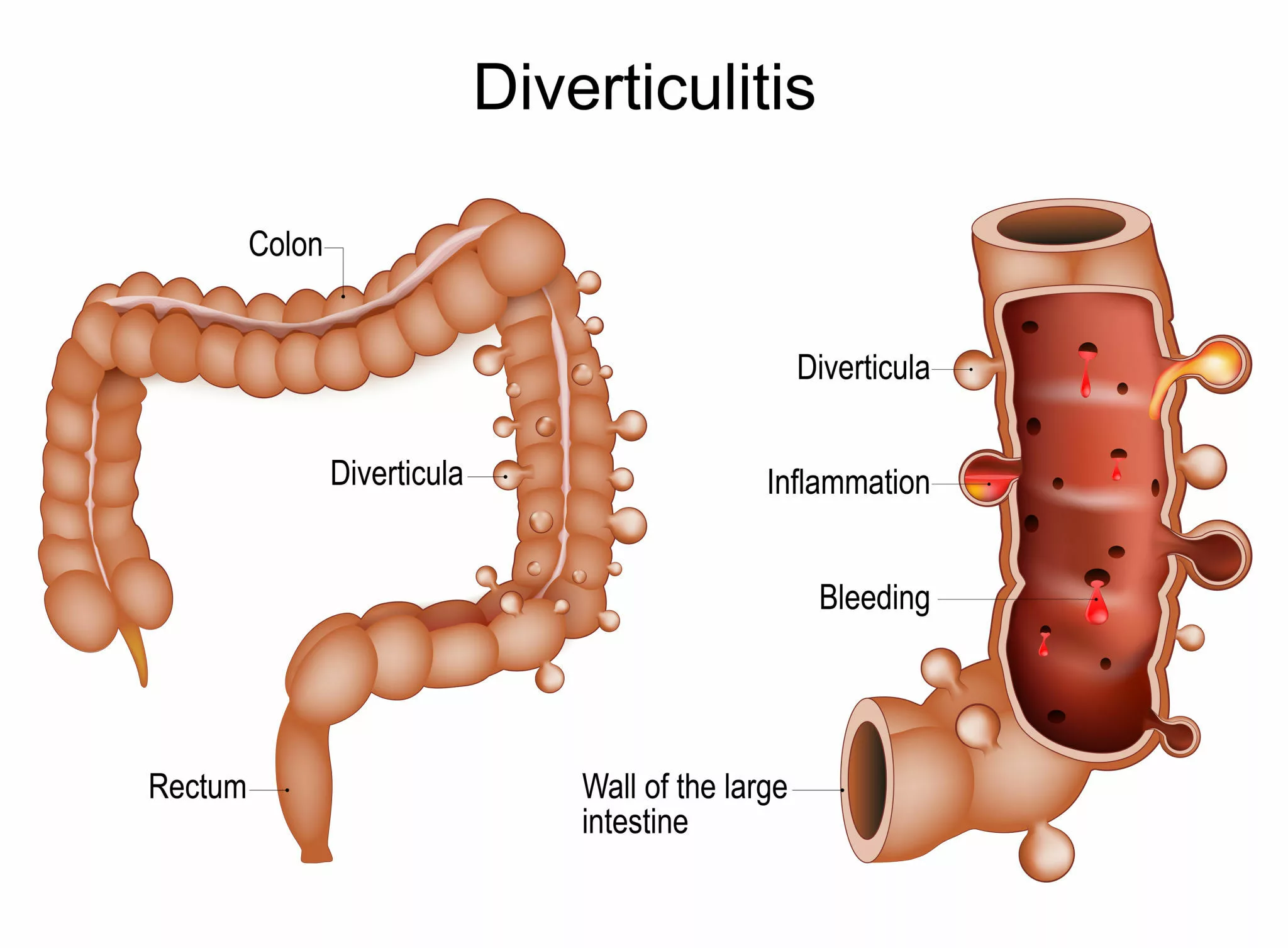 Colonic Diverticulitis - Colectomy