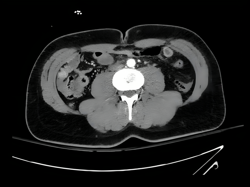 Hemoperitonum after trauma is an indication of exploratory laprotomy