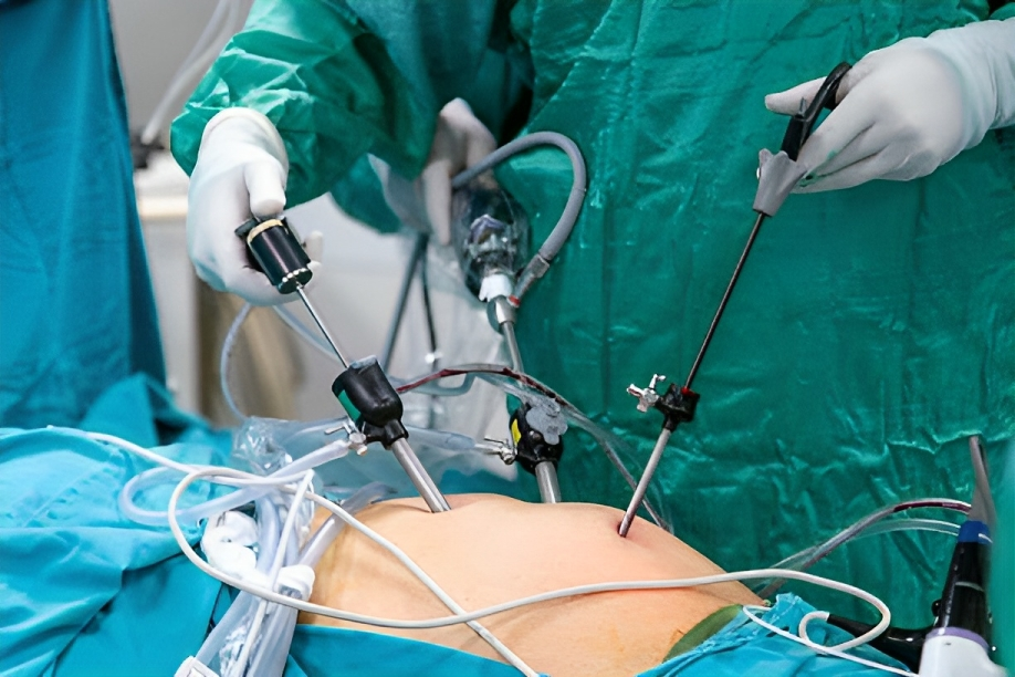 Image showing the procedure of Laparoscopic cholecystectomy