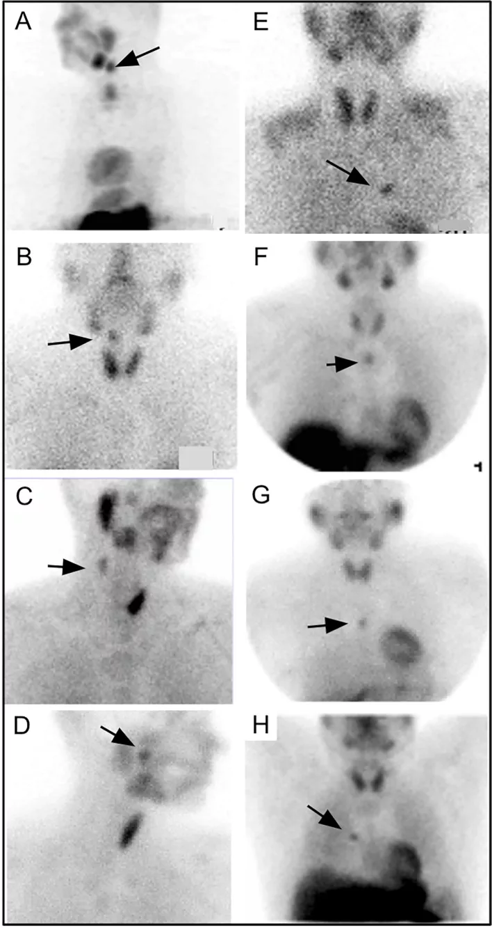 Image of Ectopic parathyroid adenomas