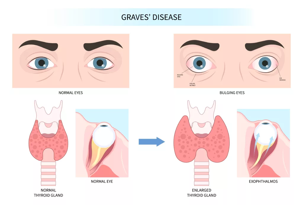 Graves' Disease