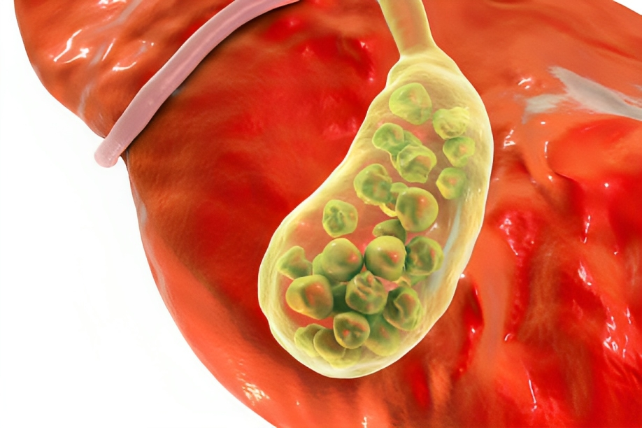 Gallstones