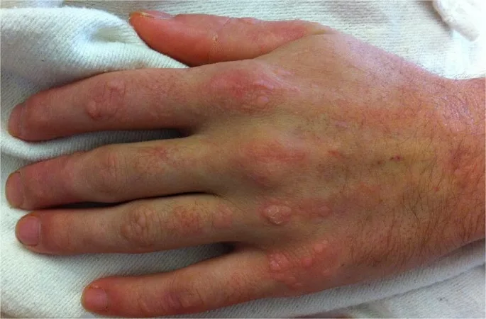 Image of patient's hand with west nile virus