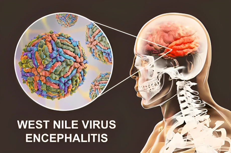 Virus causes encephalitis 