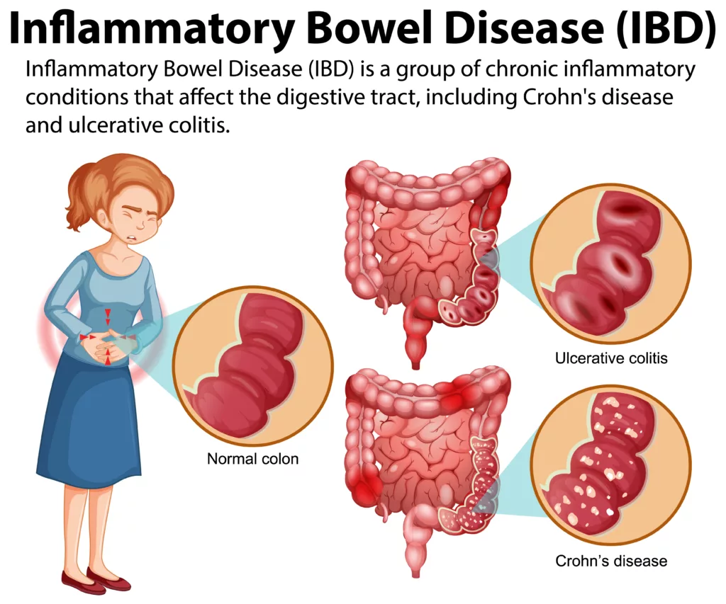 Inflammatory Bowel Disease (IBD) Infographic illustration