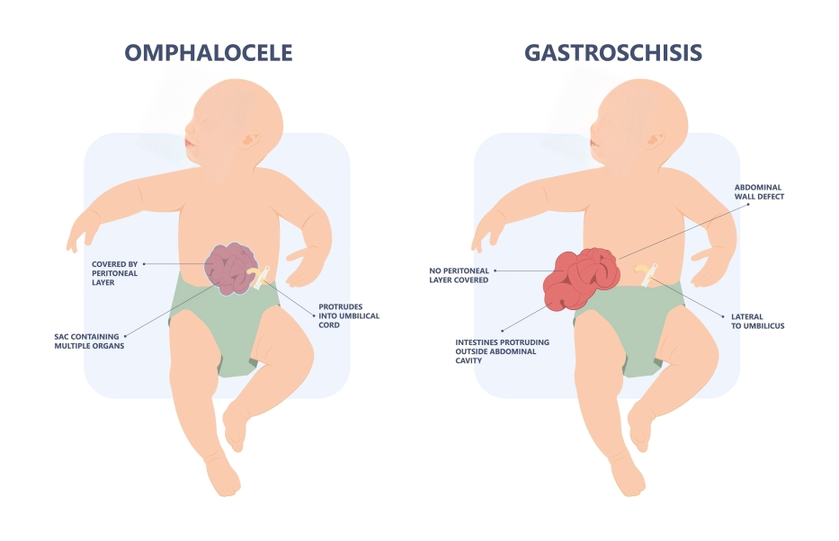 omphalocele vs. gastroschisis