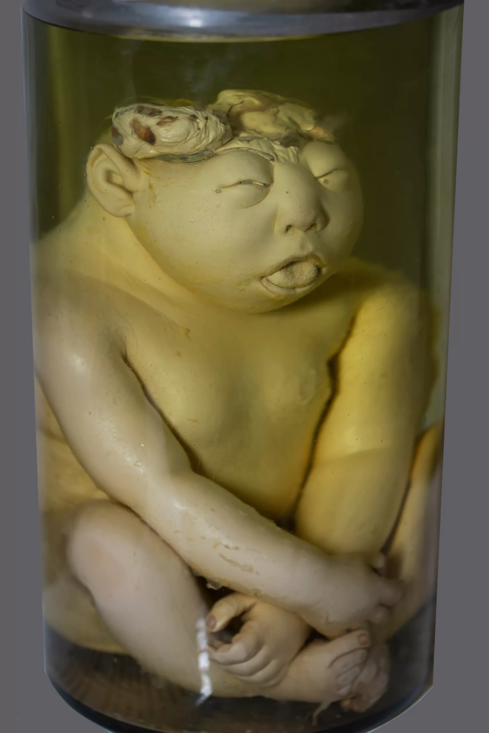 Image of an infant with the pathological development of anencephaly