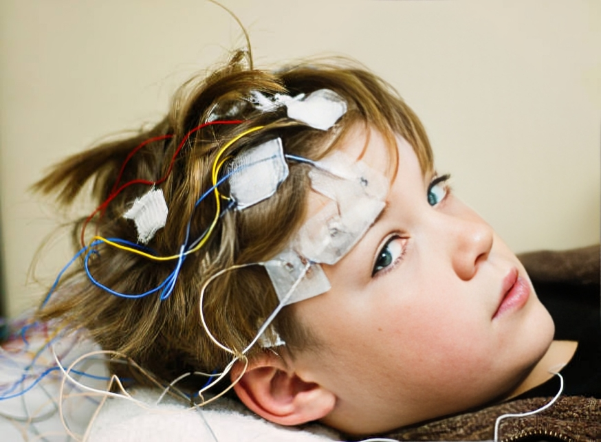 Image of A Child with Lennox gastaut syndrome having multiple episodes of seizures