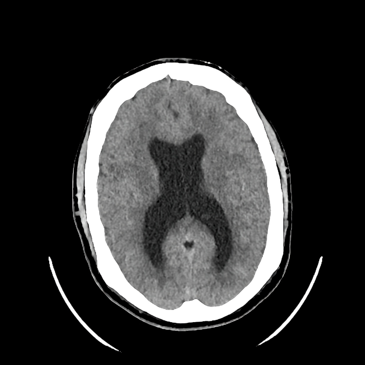 CT scan of a patient with LGS