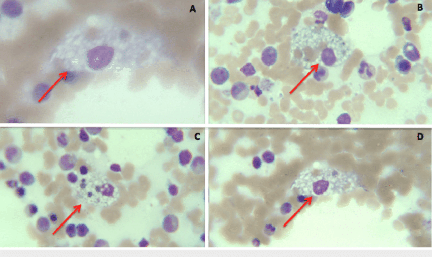 Image shows the Myelogram where the foam cells (Niemann-Pick cells: soap-suds appearance) were found.