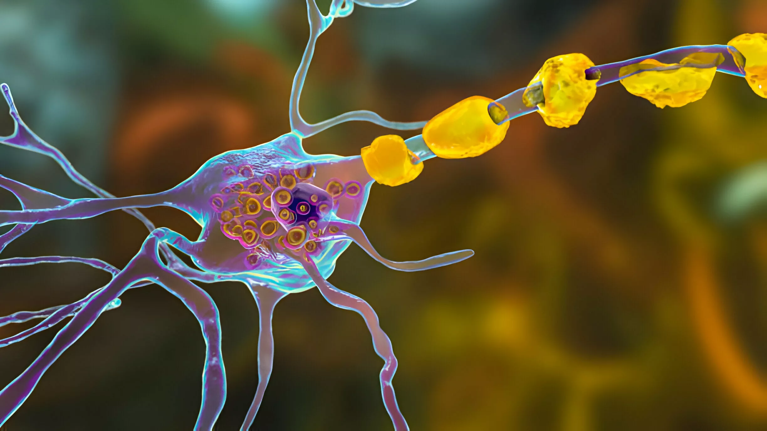 Image shows the Brain neurons in lysosomal storage disease.