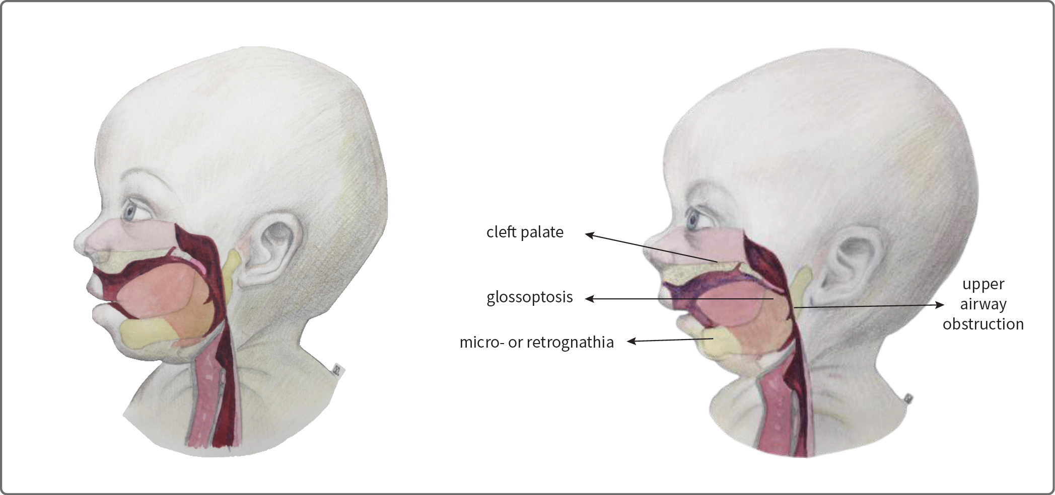 Schematic presentation of a neonate with normal anatomy of the upper respiratory tract (left) and with Pierre Robin sequence (right)