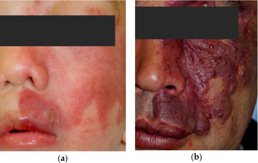 Image shows the appearance of Pork Wine Stain