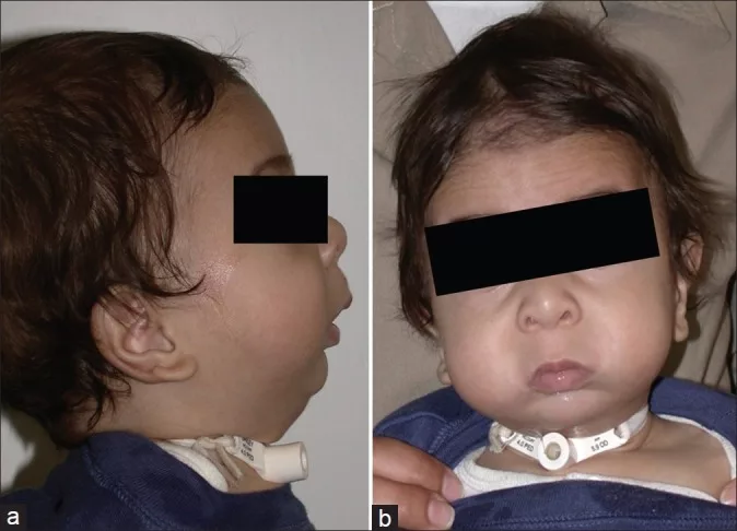 Omage of A two-year-old boy with Pierre Robin Syndrome