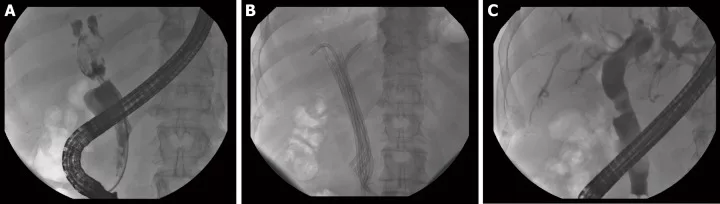 ERCP view of benign biliary stricture