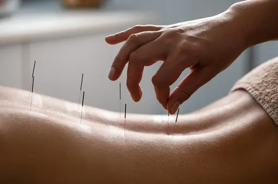 An Acupuncture procedure