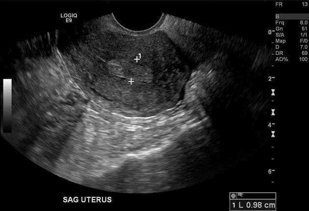 Transvaginal Ultrasound