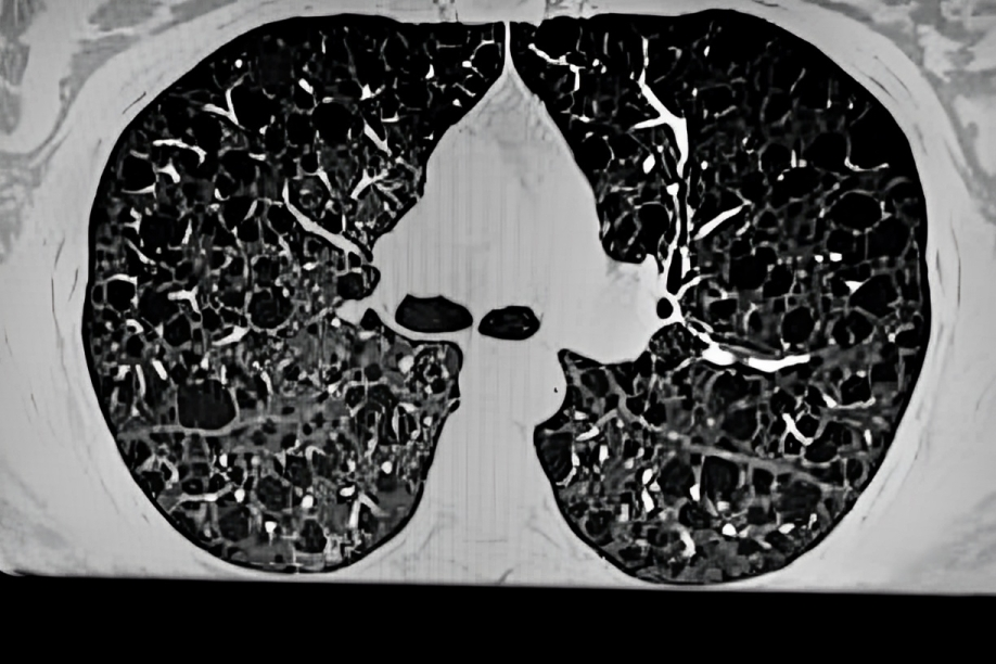 HRCT showing lung cysts