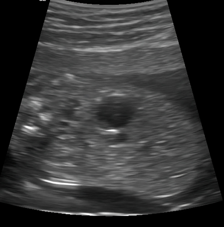 USG is showing omphalocele