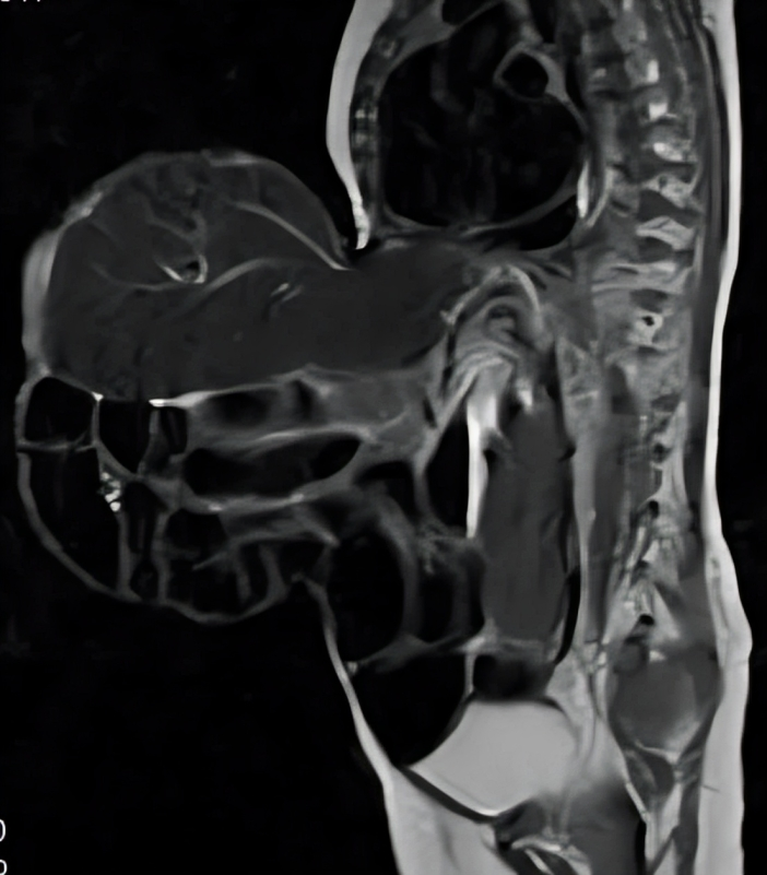 MRI showing omphalocele