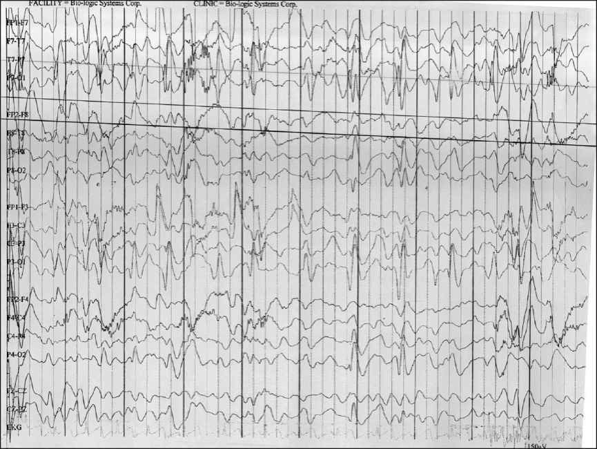 The image shows the characteristic EEG pattern in Lennox Gastaut syndrome
