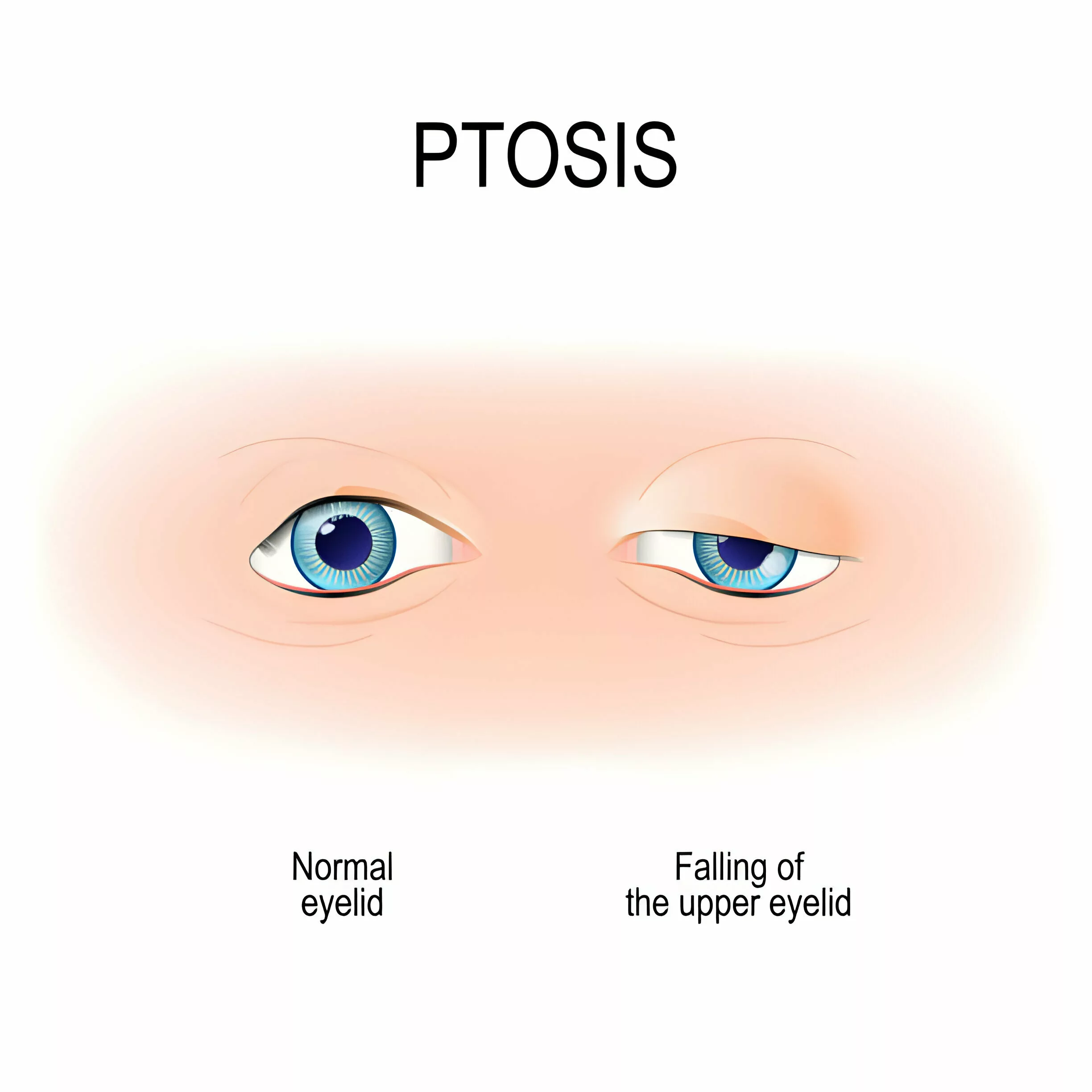 Drooping Eyelid: Ptosis