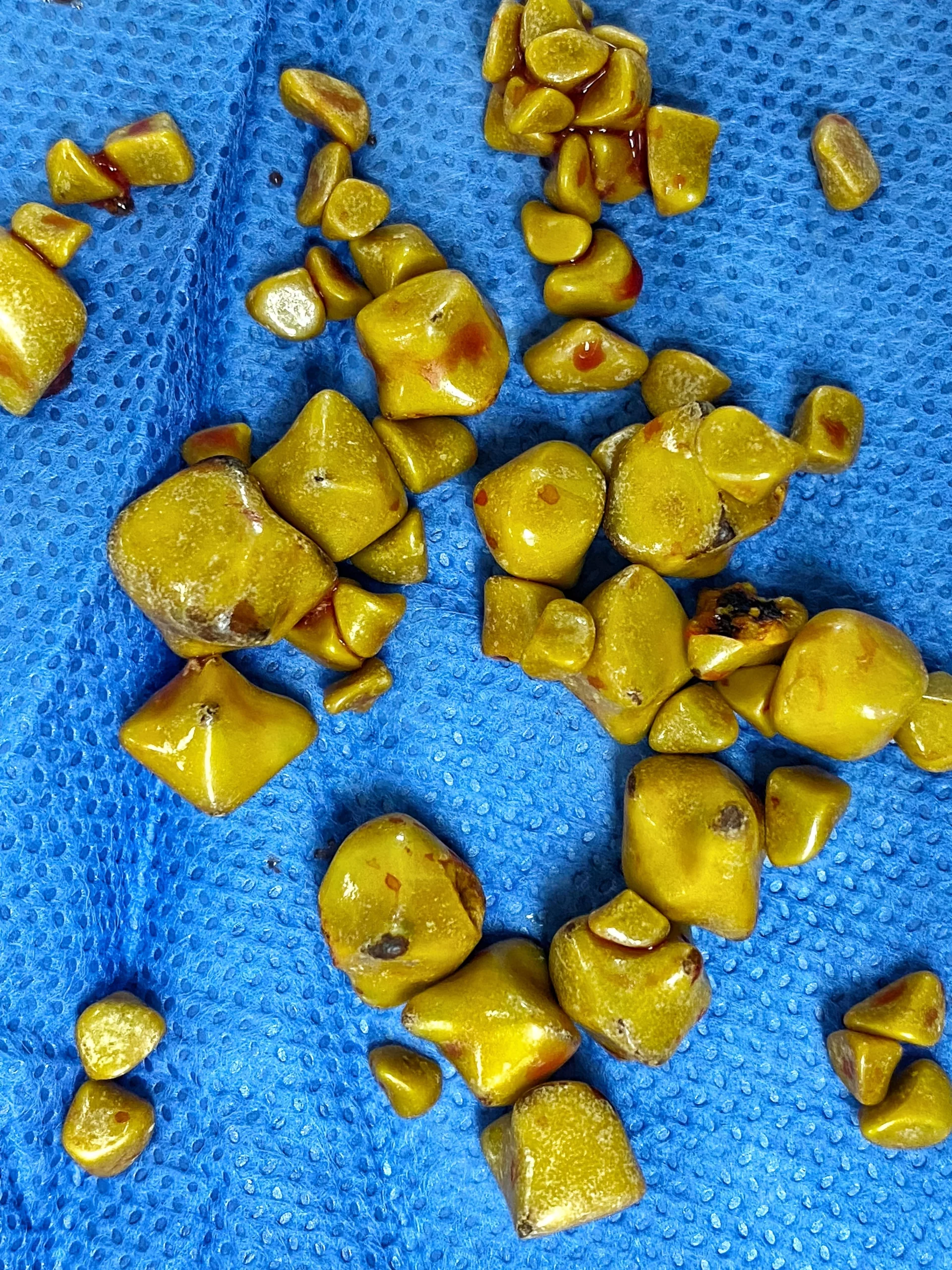 Gall Stones