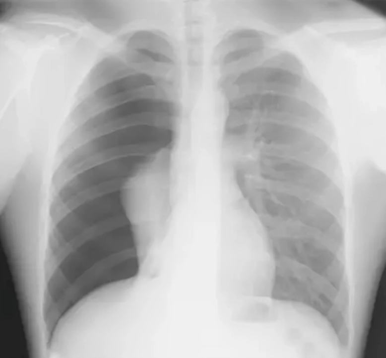 Xray of pneumothorax