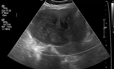 USG showing Ovarian fibroma
