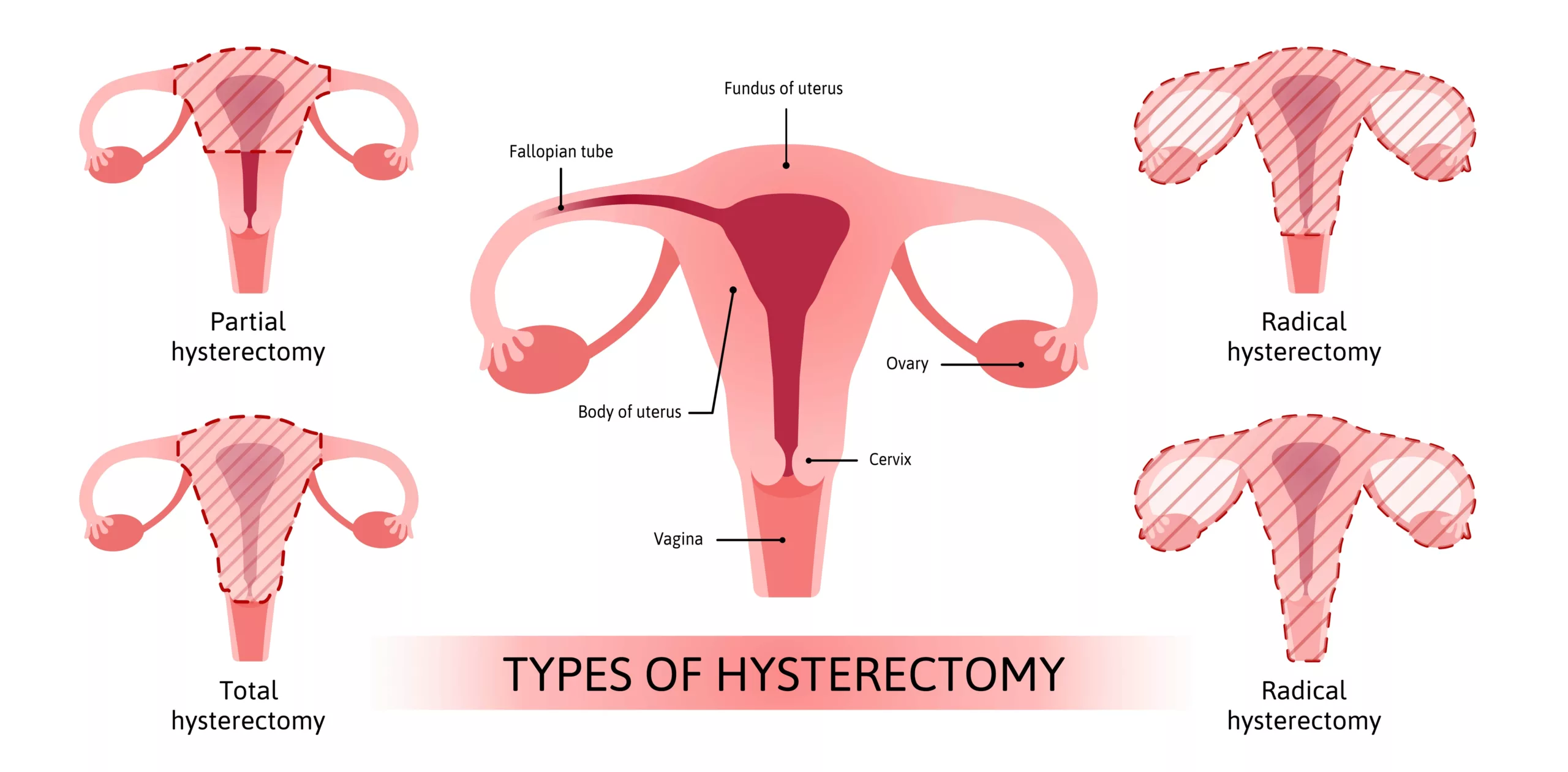 Illustration of four types of hysterectomy: partial, total, and two radical types.