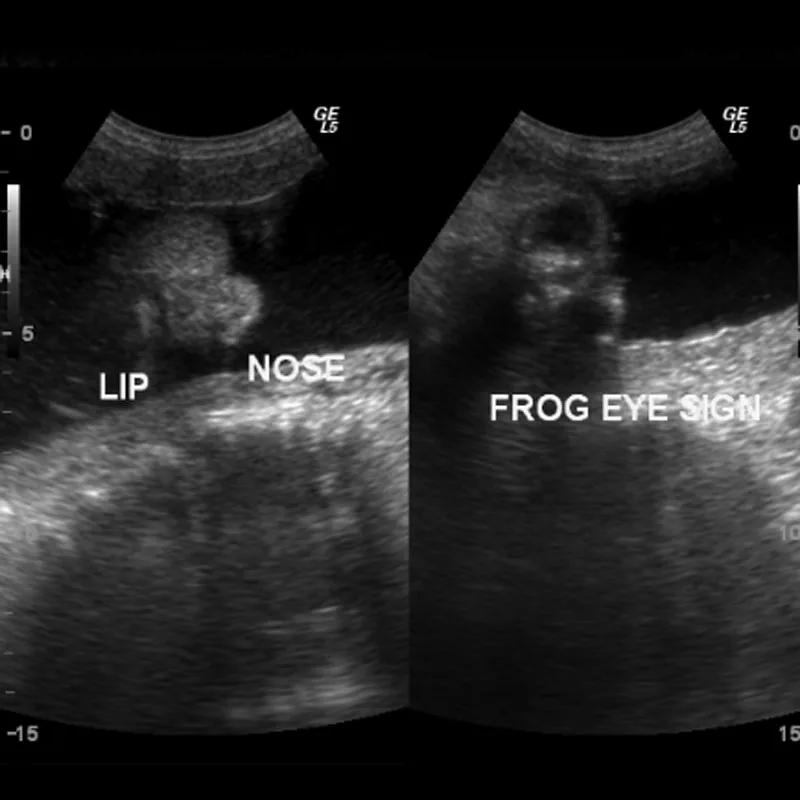 Fetal Ultrasound showing signs of Anencephaly