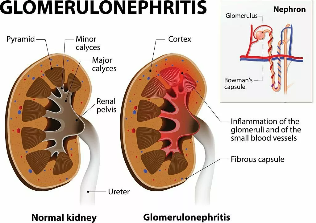 Glomerulonephritis - A type of Glomerular Disease