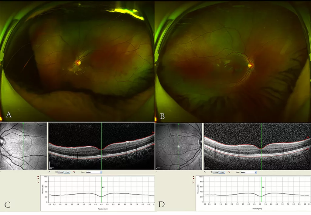 Fundus photography and OCT in idiopathic congenital nystagmus