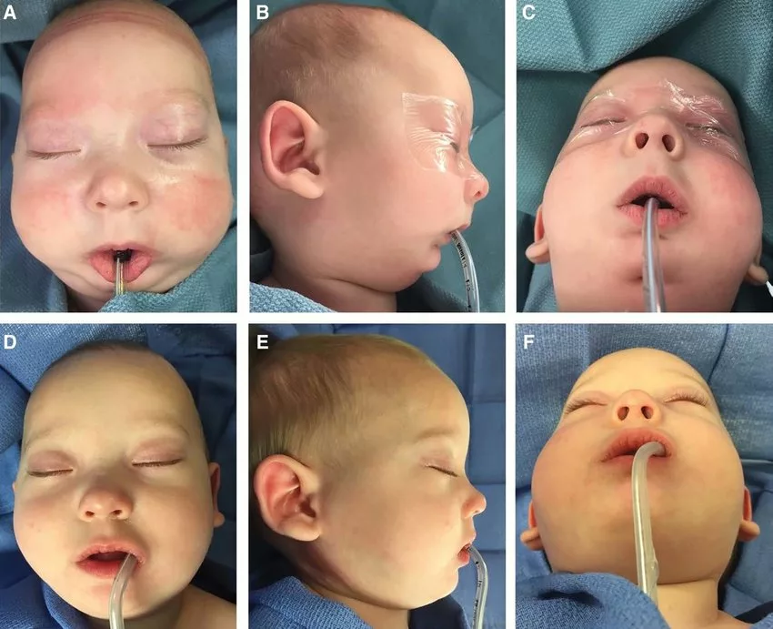 Neonate before and after Neonate before and after <yoastmark class=