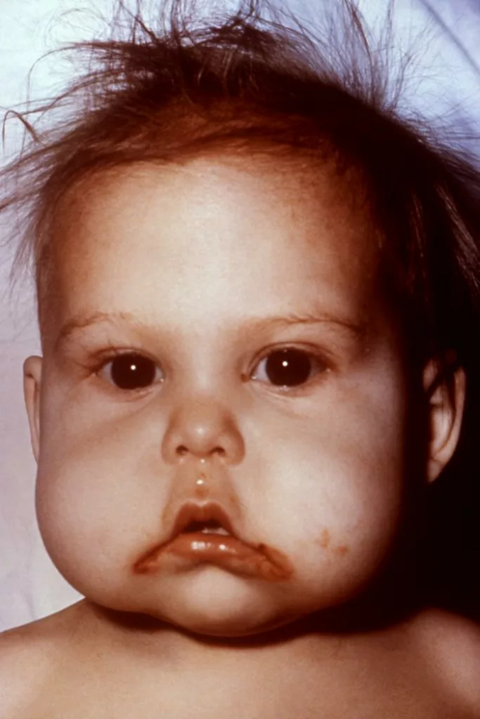 an anterior view of an infant’s face, which exhibited symptoms indicative of kwashiorkor, a dietary protein deficiency
