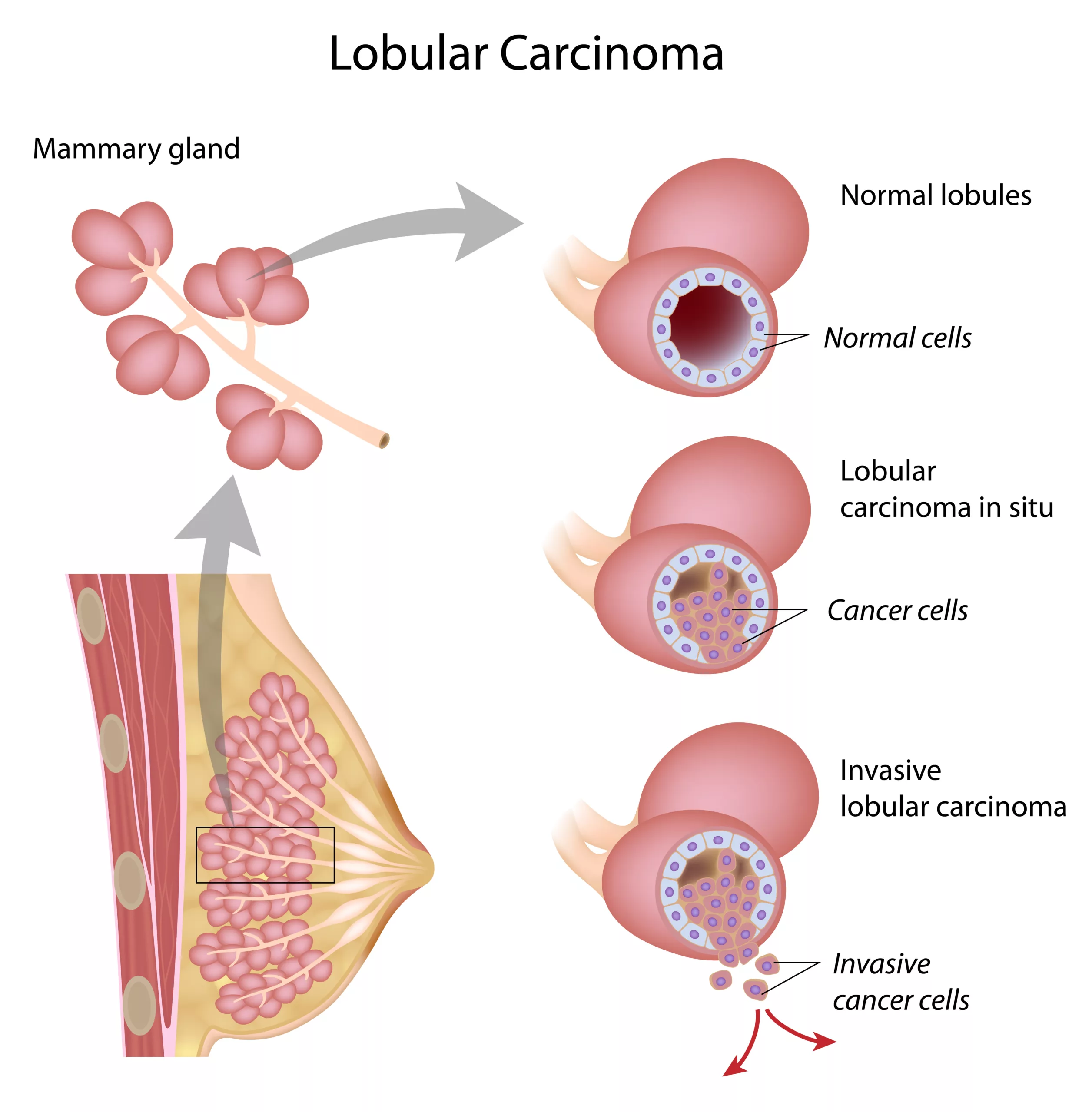 Invasive lobular carcinoma (ILC)