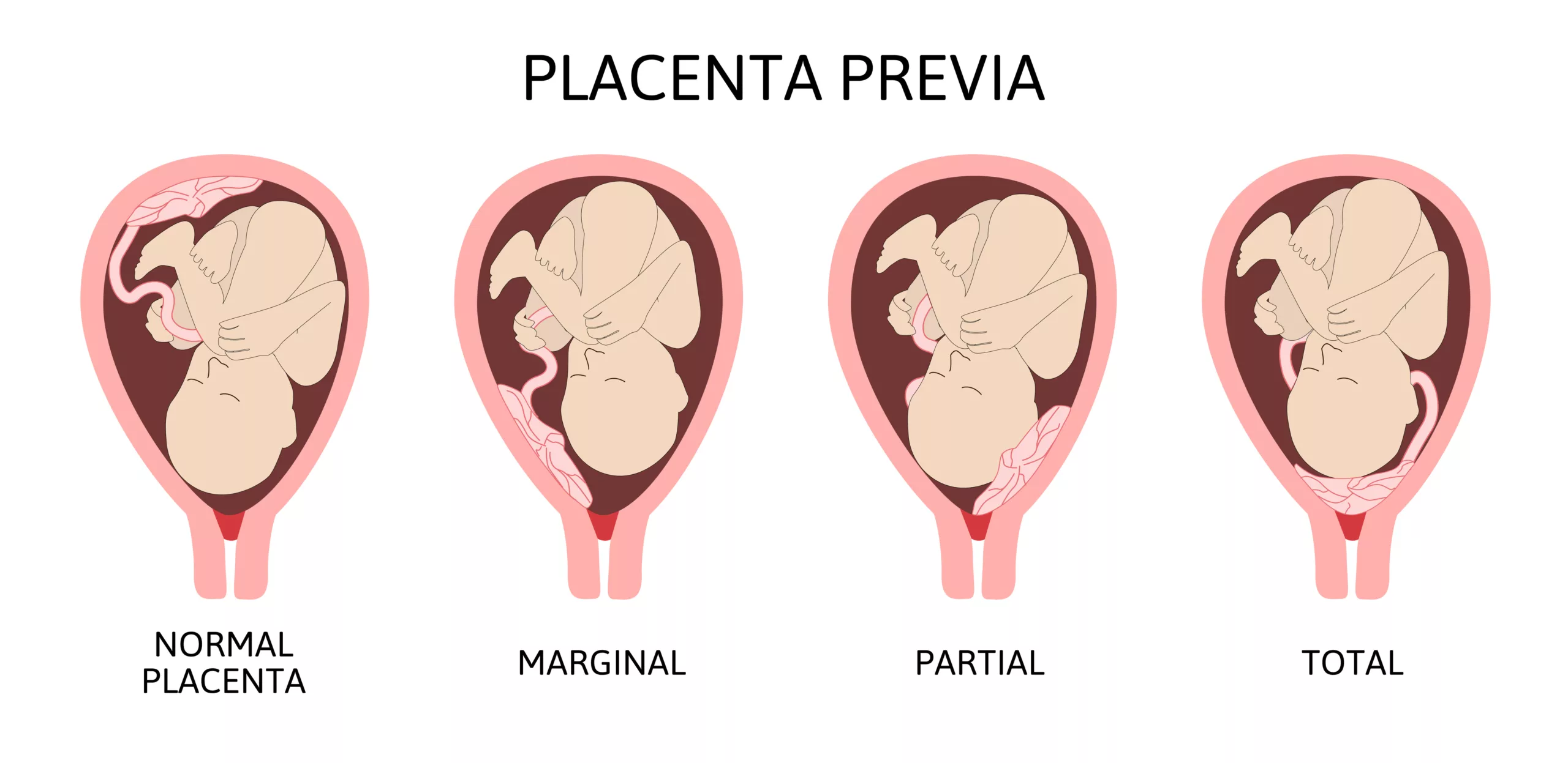 Different Placental Locations During Pregnancy. 