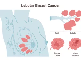 Invasive Lobular Carcinoma (ILC)