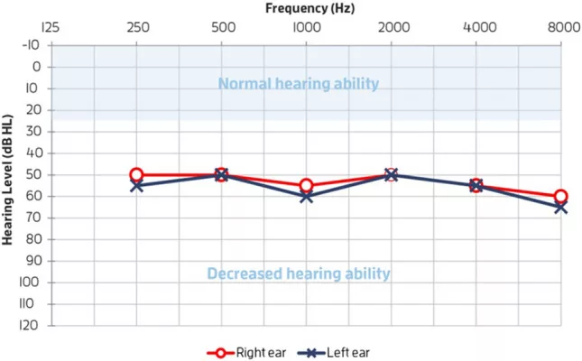 Audiogram of patient comparing PTT with normal hearing abilitiy.