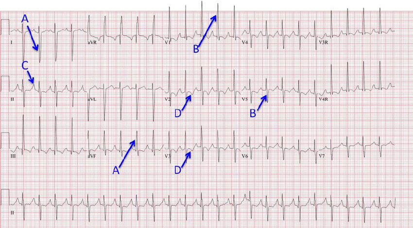 ECG findings of a patient with primary pulmonary hypertention
