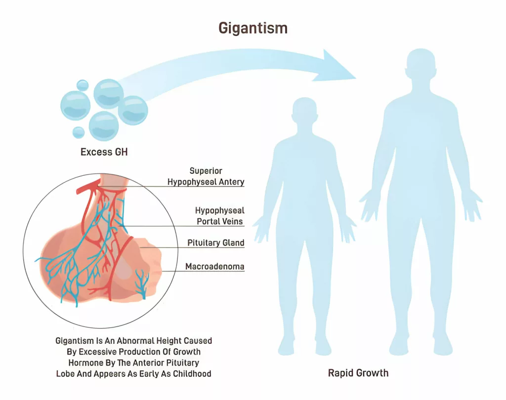 Gigantism