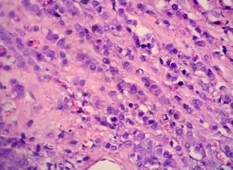 Linear or single-cell file pattern of infiltration is characteristic of lobular carcinoma