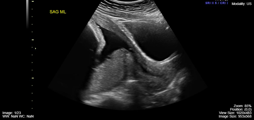 Ultrasound Showing Placenta Previa 