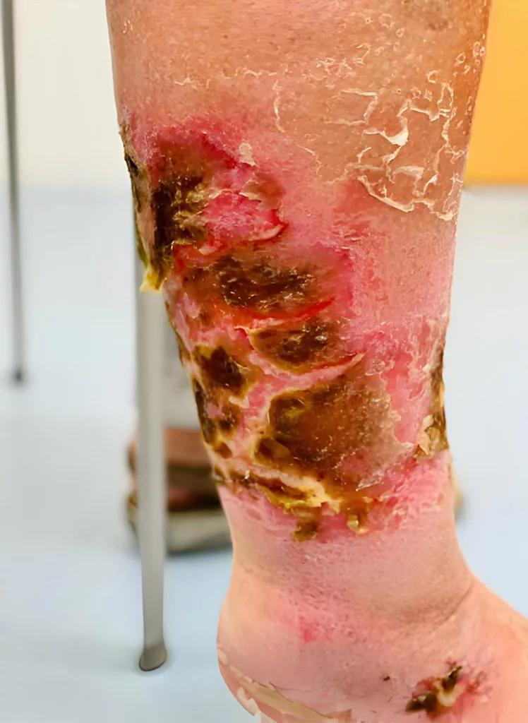 Bullous Pemphigoid seen on the leg of a patient