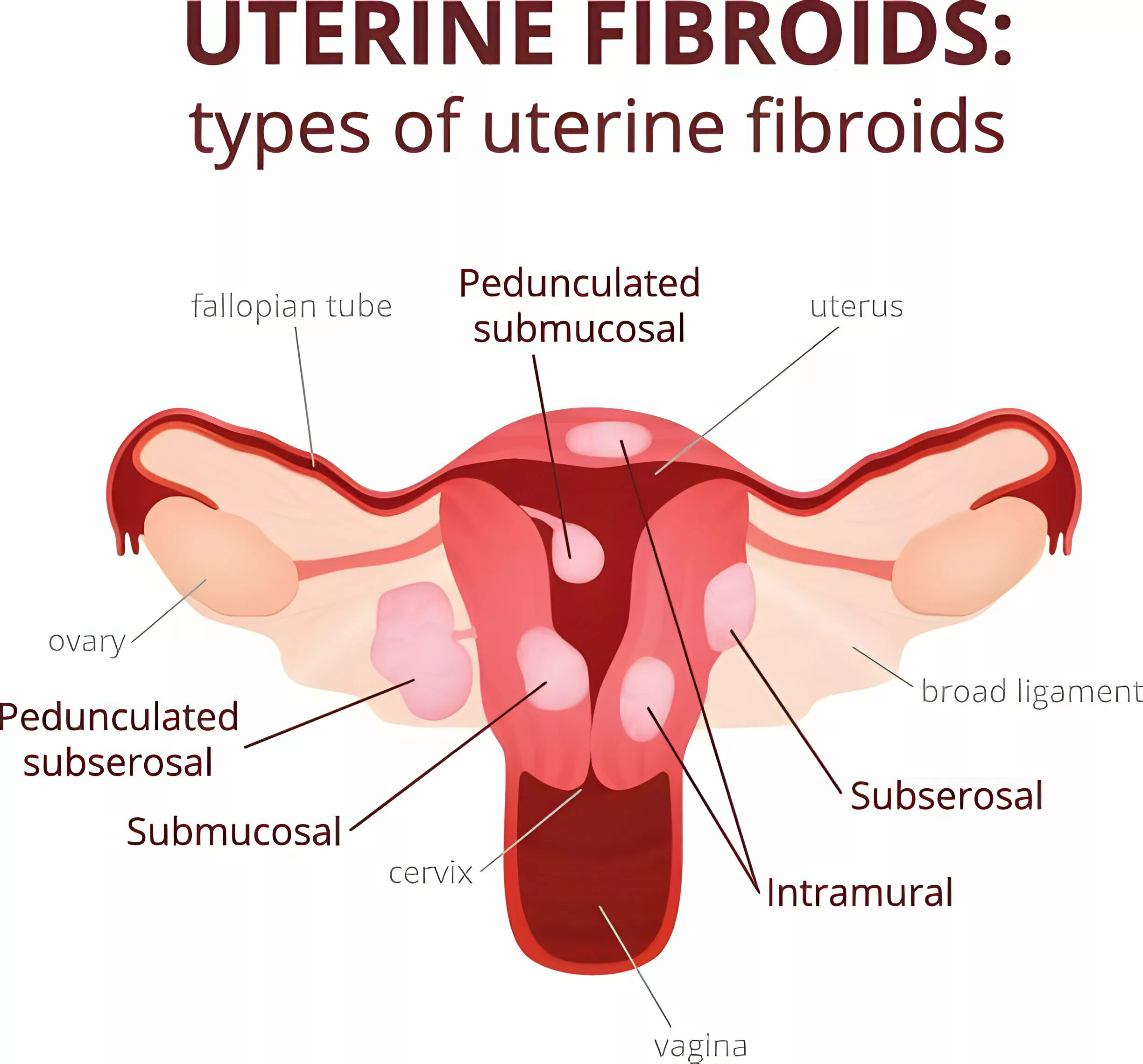 Types of Uterine Fibroids