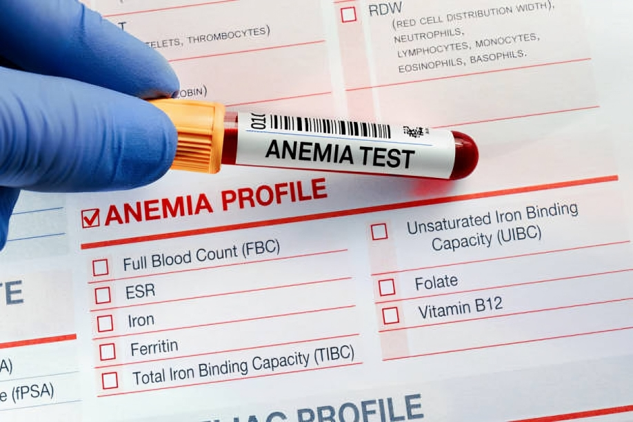 Some important laboratory tests to diagnose anemia