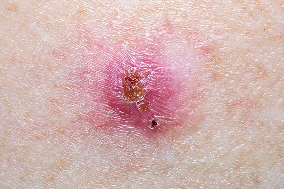 Basal-cell carcinoma