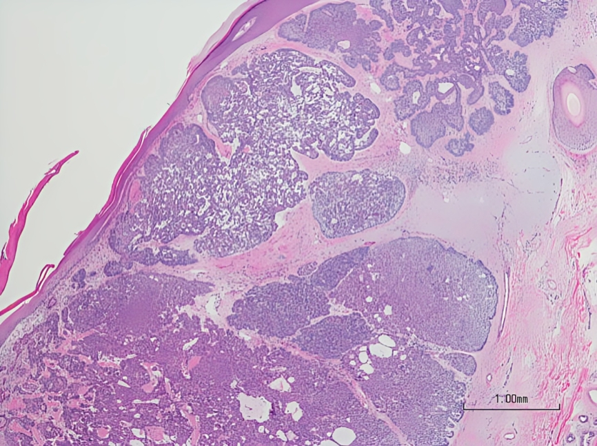 Histopathology of Basal-cell carcinoma showing aggregates of basal cells and small cytoplasm, hyperchromatic nuclei, fibromyxoid stroma, and tumor retraction spaces.