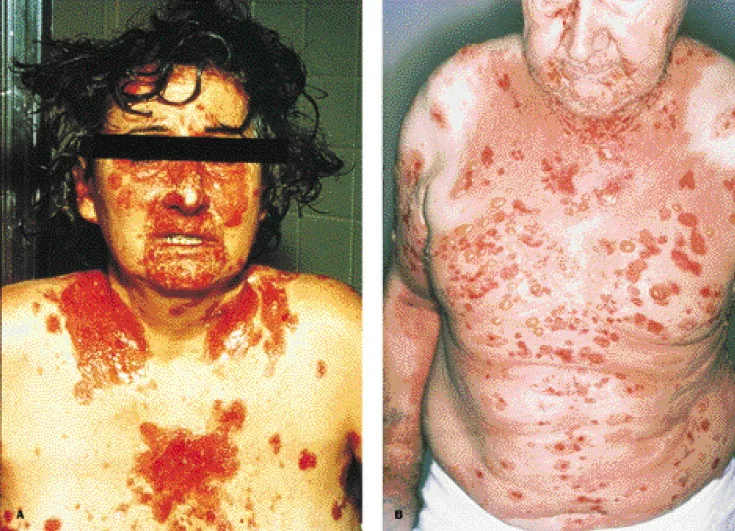 Left image is of a patient with Pemphigus vulgaris and right image is of a patient with Bullous Pemphigoid